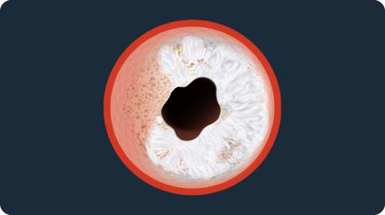 Cross-sectional illustration of an artery with concentric calcified plaque buildup