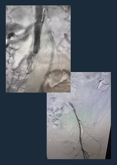 Dr. Constantino Peña Case Review: Bilateral Iliac Disease