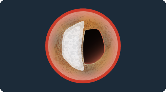 Cross-sectional illustration of an artery with eccentric calcified plaque buildup