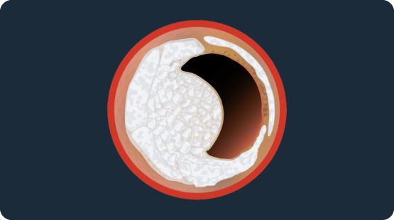 Cross-sectional illustration of an artery with nodular calcified plaque buildup