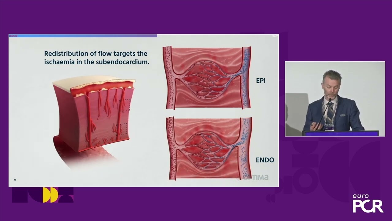 Shockwave Reducer at EuroPCR 2024: Mechanism of Action