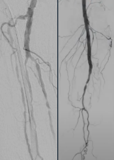 Shockwave E8 Case Review with Dr. Michael Siah & Dr. Kyle Reynolds