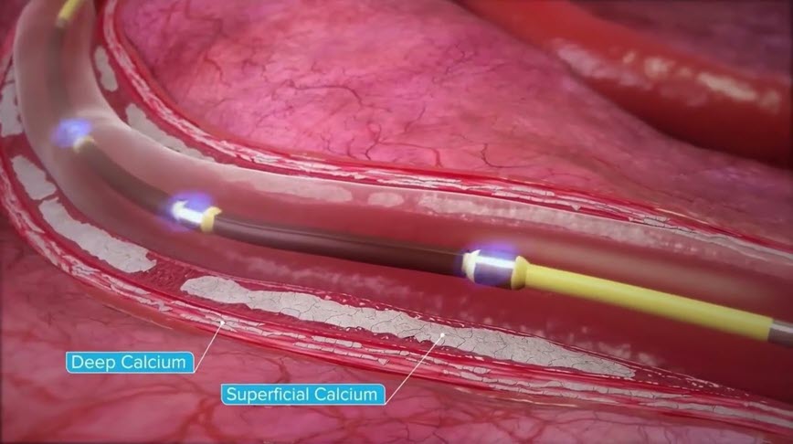 Shockwave IVL Mechanism of Action (MOA) Overview