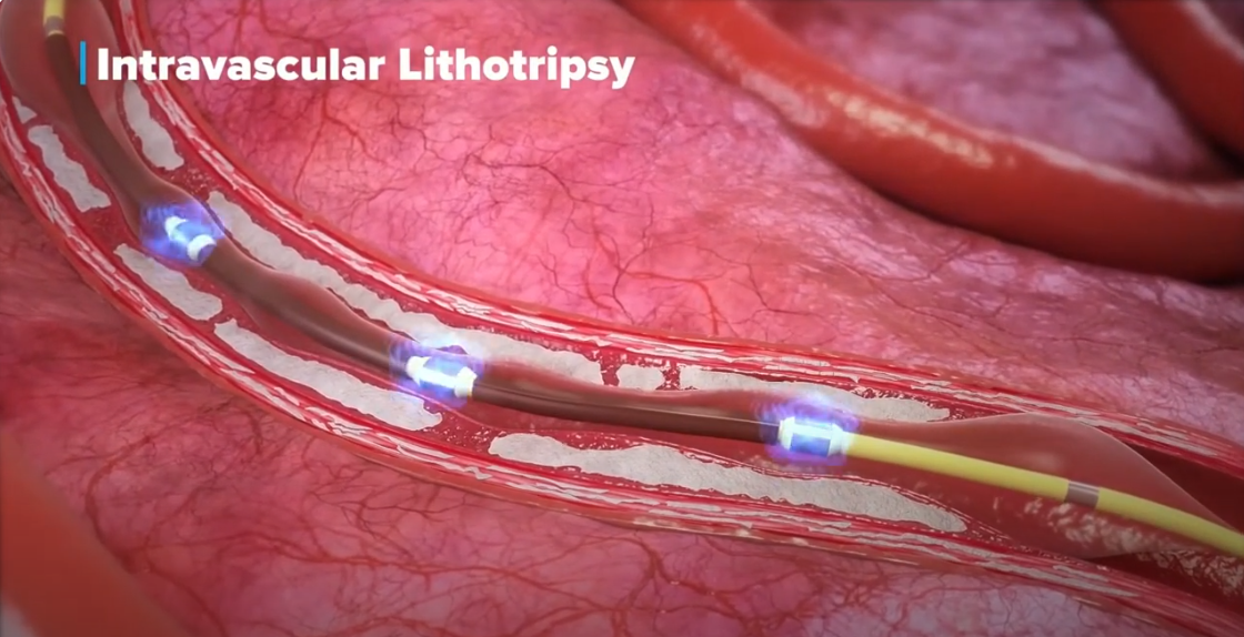 Shockwave IVL Mechanism of Action (MOA) - Japanese Translation & Subtitles