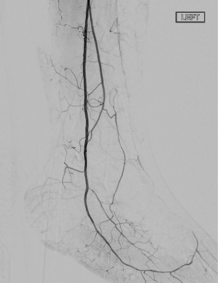 Baseline angiograms showing normal inflow/outflow, but narrowed distal PT and heavily stenosed lateral plantar arteries