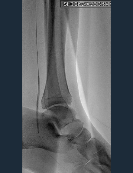 10 cycles of 3.5 mm Shockwave E8 delivered in distal posterior tibial artery and proximal lateral plantar arch.