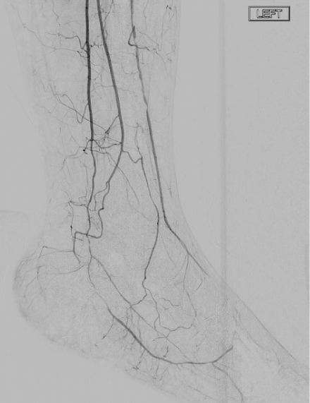 foot angiograms showing widely patent distal PT and lateral plantar arteries with excellent digital blood supply to 2nd and 3rd toes