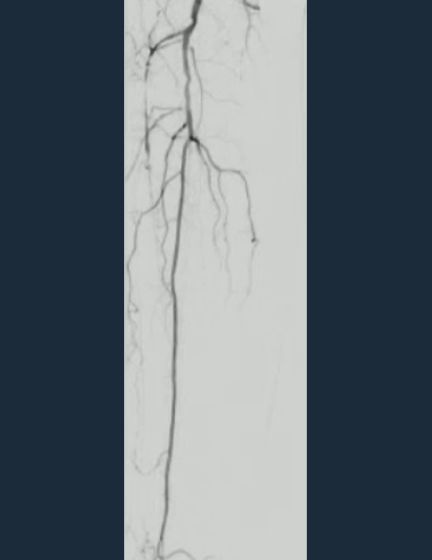 Baseline Angio showing diffuse Anterior Tibial disease