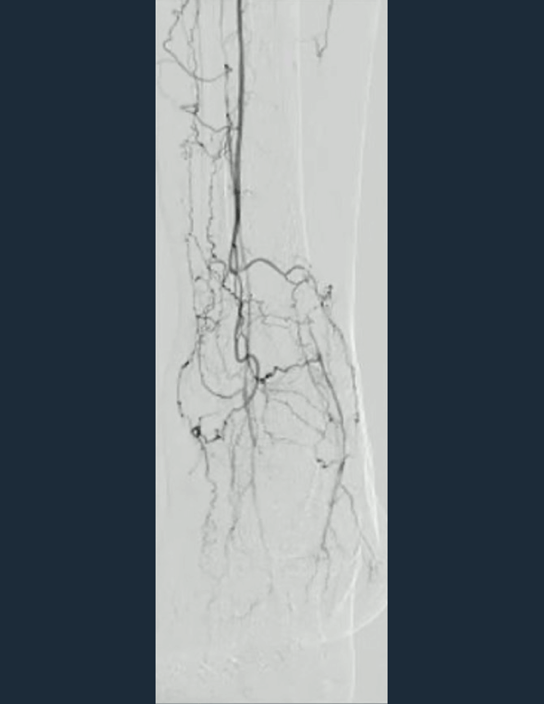 AP view shows no plantar arch or flow to metatarsals arteries and no pedal pulse present