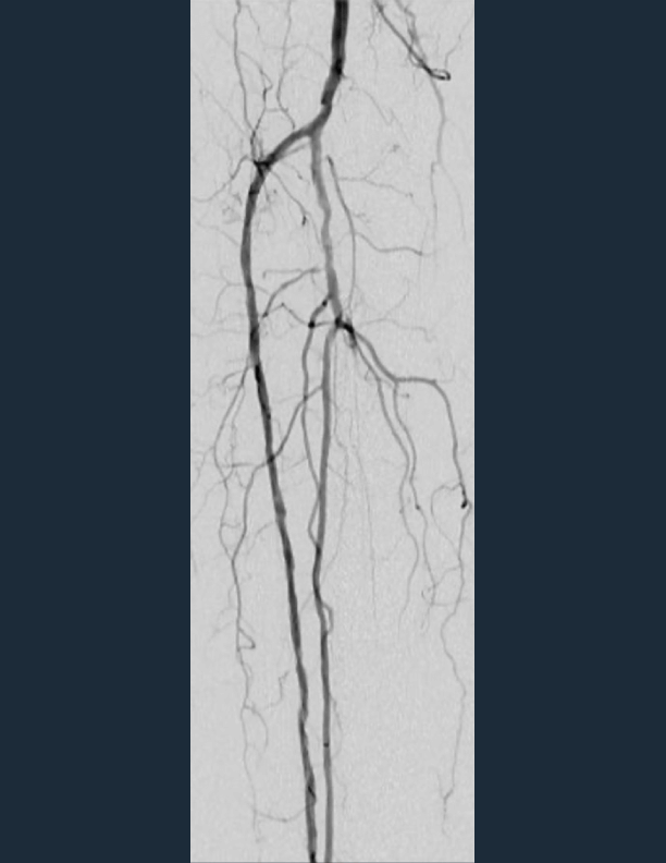 angio during shockwave e8 treatment