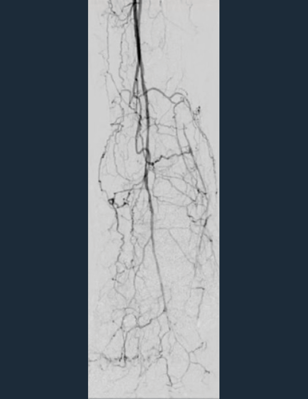 Final angio shows direct flow to metatarsal arteries