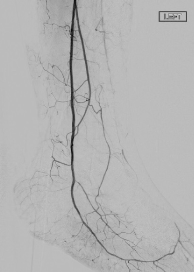 Shockwave E8 for the Treatment of the Posterior Tibial and Lateral Plantar Arteries