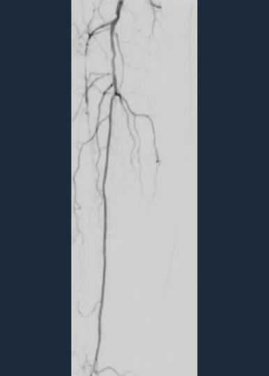 Shockwave E8 for the Treatment of a Long Anterior Tibial Occlusion