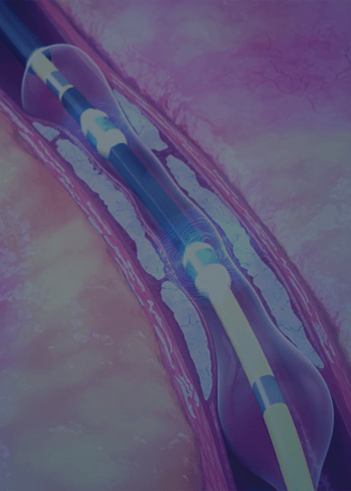 Head-to-Head ROLLING-STONE Registry Showcases Safety of IVL over Atherectomy