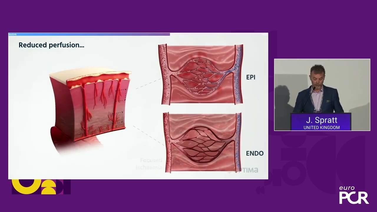 Shockwave Reducer at EuroPCR 2025: Reducer Mechanism of Action
