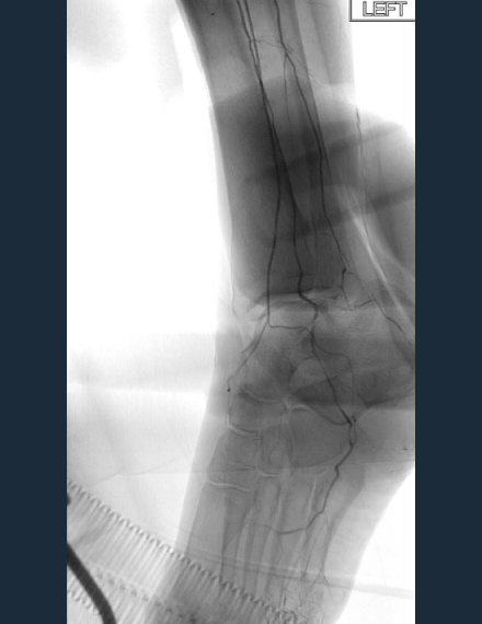 Shockwave Javelin for below the ankle revascularization In a patient with CLTI