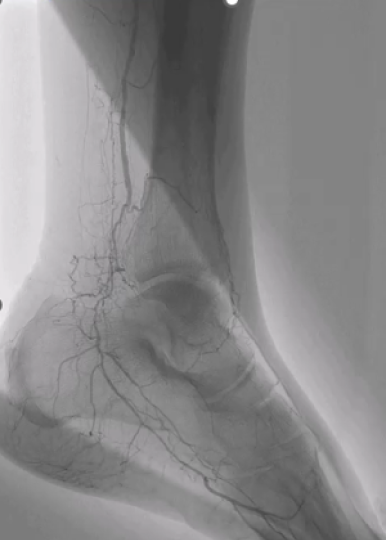 Shockwave Javelin Peripheral for the treatment of a long anterior tibial artery occlusive lesion