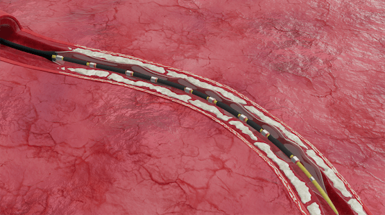 Image for Your doctor inserts the Shockwave IVL device