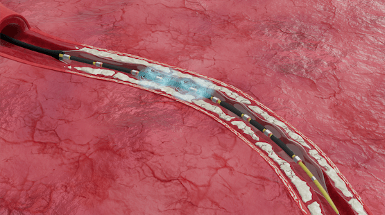 Image for Ultrasonic sound waves break up calcium buildup